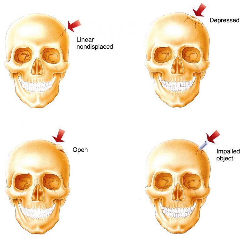 Vỡ Xương Hộp Sọ Bvntp